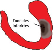 Zone des Infarktes