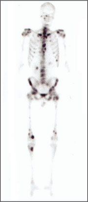 Skelettszintigramm mit zahlreichen Metastasen